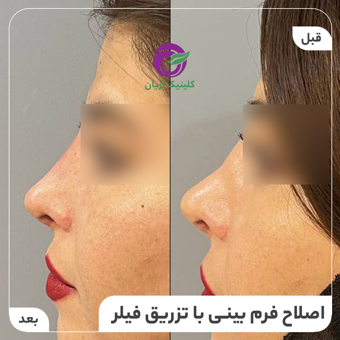 تصاویر قبل و بعد از تزریق ژل